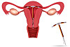 bivirkninger ved hormonspiral